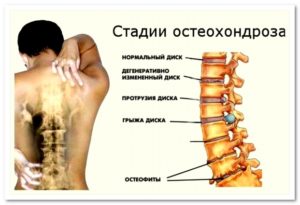 Что такое остеохондроз. Стадии остеохондроза. Как проявляются и чем лечатся