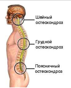 стадии остеохондроза позвоночника