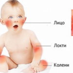 Диатез у детей на лице и теле