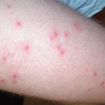 Зудящему дерматиту подверженны области тела с нежной, чувствительной кожей.