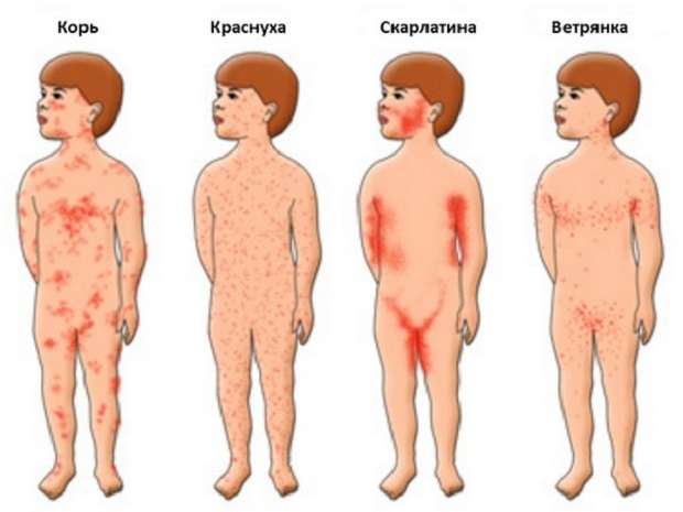 Локализация сыпи при различных болезнях у детей