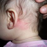 Себорейный дерматит у детей1