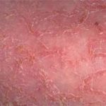 Как выглядит кожа при сухом дерматите1