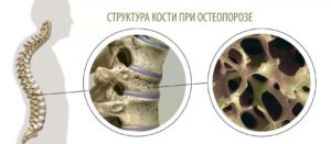 Структура кости при остеопорозе