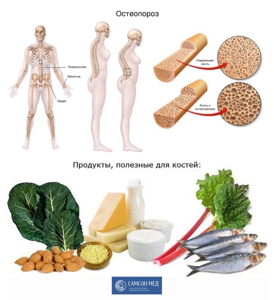 правильное питание при остеопорозе