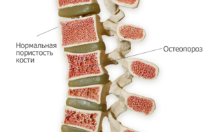 разновидности остеопорозаю остеопороз позвоночника