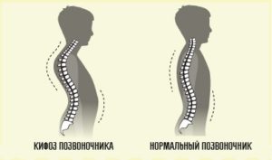 синдром круглой спины