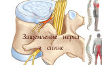 Защемление нерва в спине, причины, симптомы, лечение