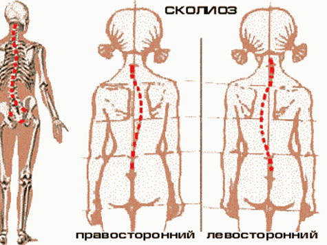 Сколиоз - причины, симптомы, диагностика и лечение