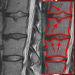 Рентгеновский снимок межпозвоночной грыжы шморля