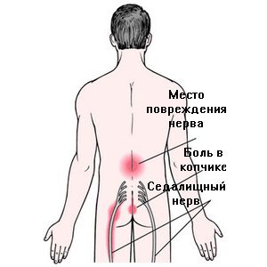 Воспалительные или патологические процессы в спине в области поясницы