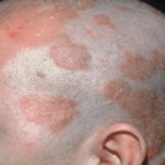 Себорейный дерматит у взрослых:фото дерматита на голове