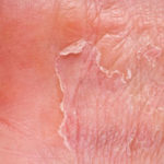 Как выглядит кожа при сухом дерматите