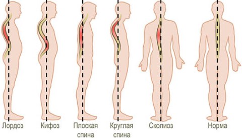 Врожденное заболевание мышц спины и позвоночника