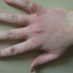 Зудящий дерматит на руках