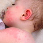 Симптомы пищевой аллергии у детей (грудничков)