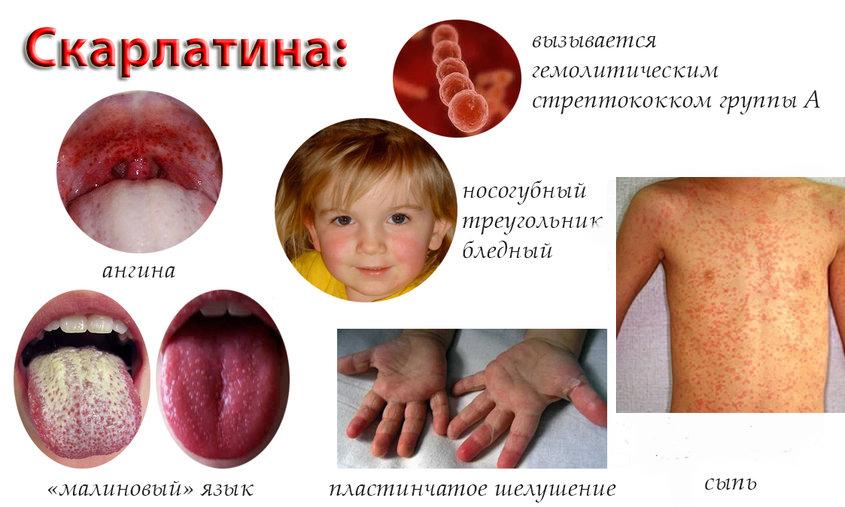 Главные Симптомы скарлатины у детей