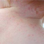 Атопический дерматит на спине у ребёнка