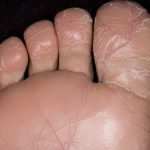 Сухой дерматит на пальцах ног