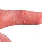 Сухой дерматит на пальцах рук