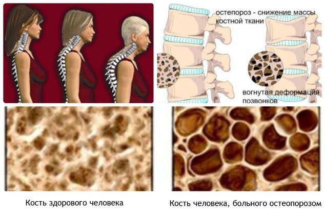 разновидности остеопороза