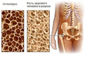 Как выглядят кости здорового человека и кости пораженные остеопорозом